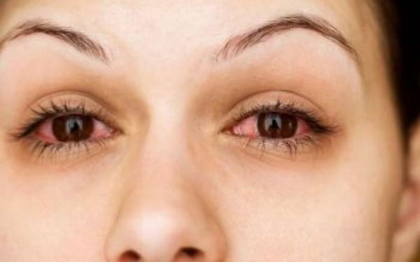 De ce afecţiuni ai putea suferi dacă ochii sunt roşii
