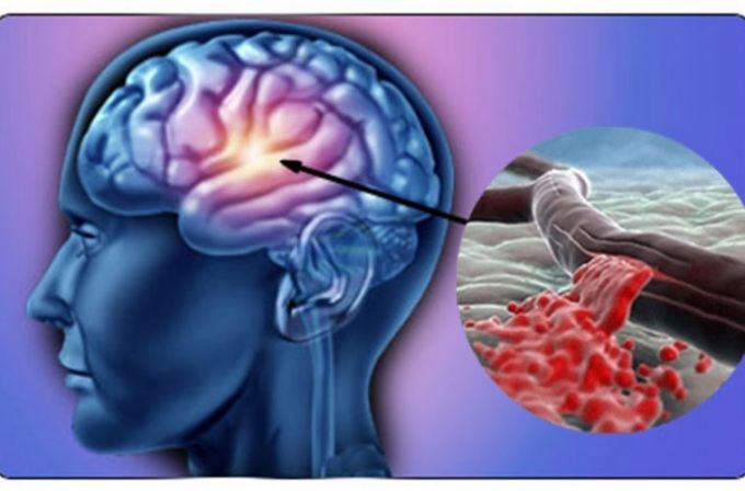 Accidentul Vascular Cerebral: Simptome, Riscuri si Diagnostic